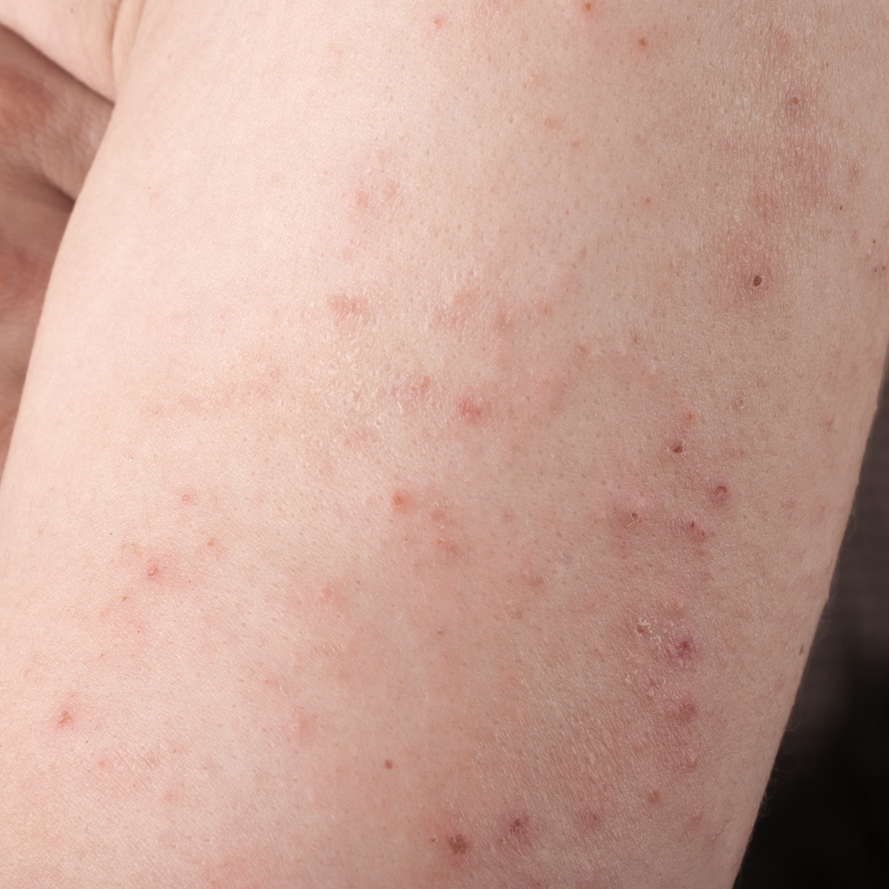 Атопический дерматит: что нужно знать для поддержания здоровья кожи