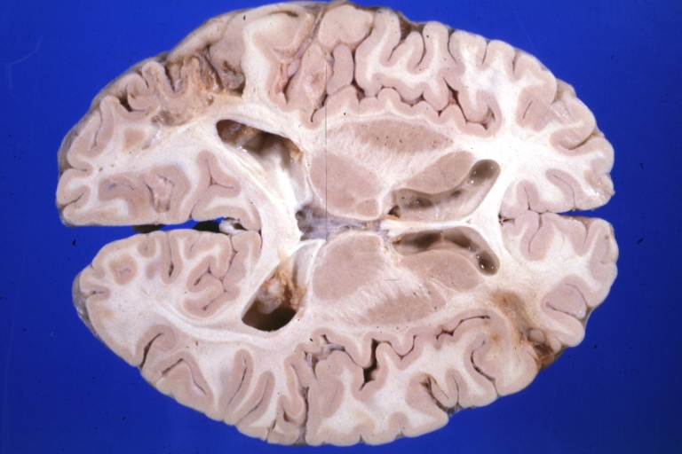 Резидуальные изменения головного мозга