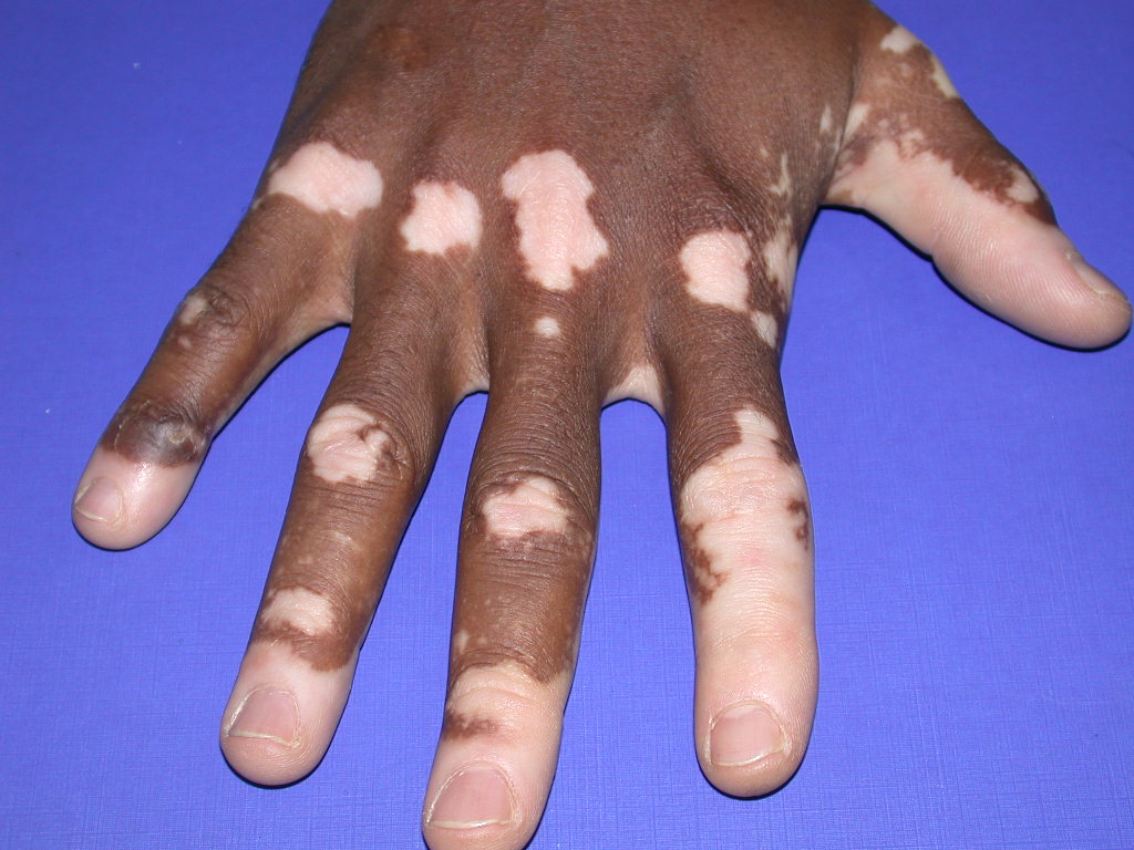 Пигментация кожи при аддисоновой болезни