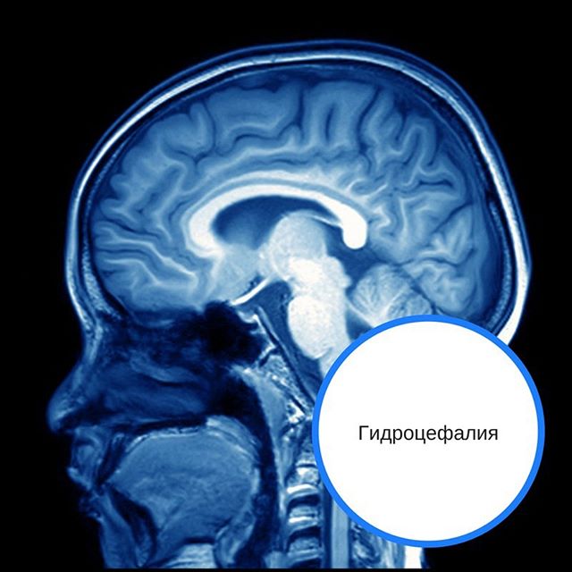 Причины гидроцефалии мозга. Арахноидальная гидроцефалия. Наружная гидроцефалия головного мозга. Обструктивная гидроцефалия. Гидроцефалия мозжечка.