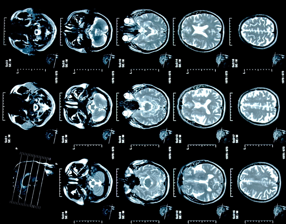 Сканирование головного мозга определит вид лечения социофобии